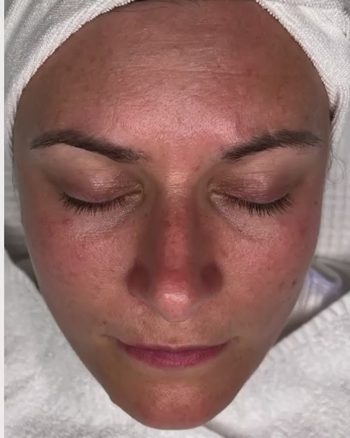 Hydrafacial Intense – Gezielte Gesichtsbehandlung mit Booster
